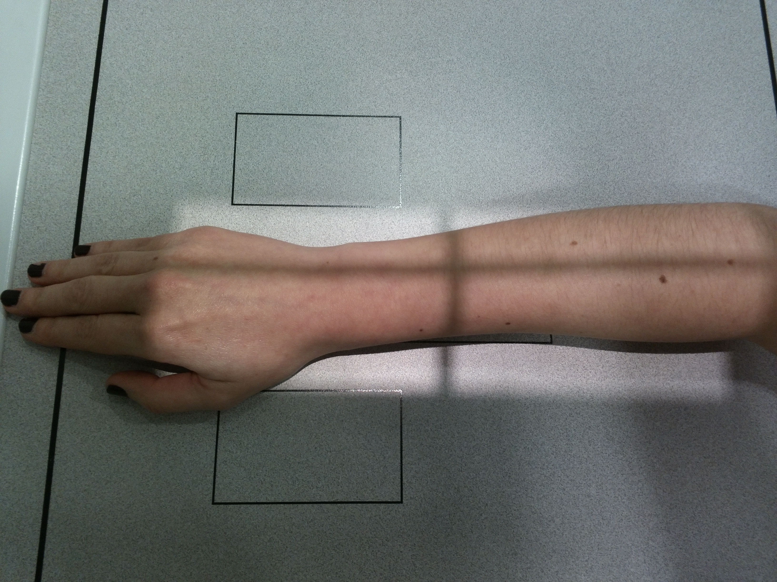 Radiografía PA Antebrazo